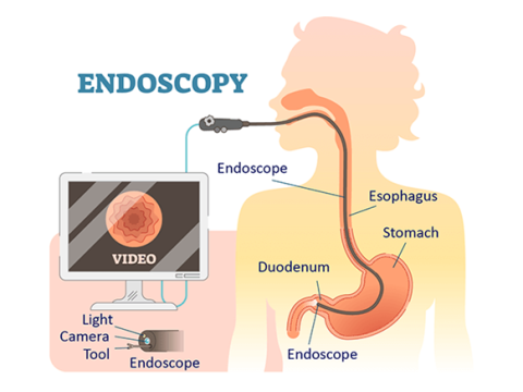 What Is an Endoscope?